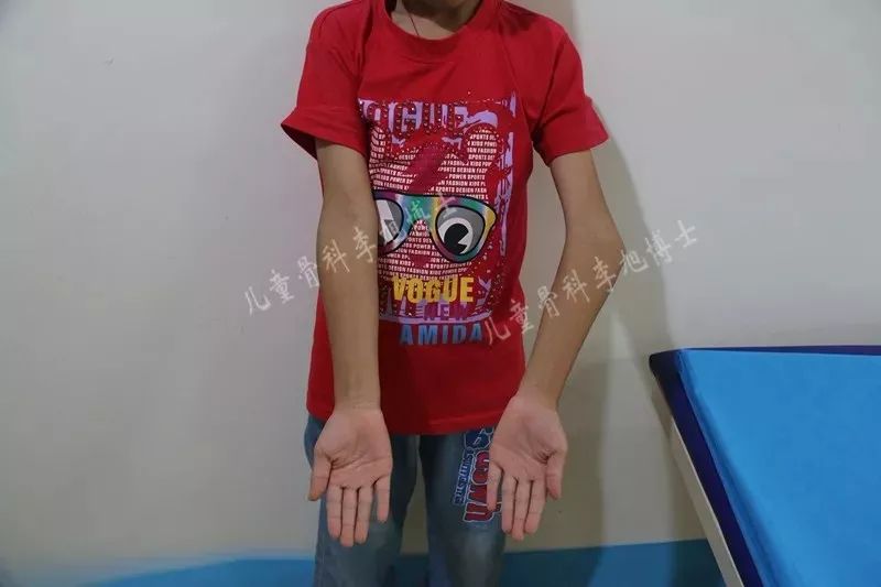 胳膊肘"往外拐"好过"往里拐"!