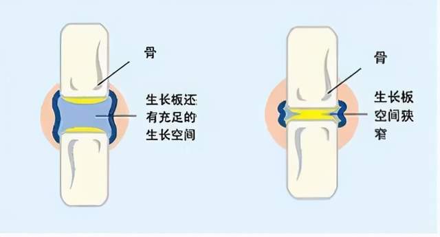 骺板和骺软骨图片