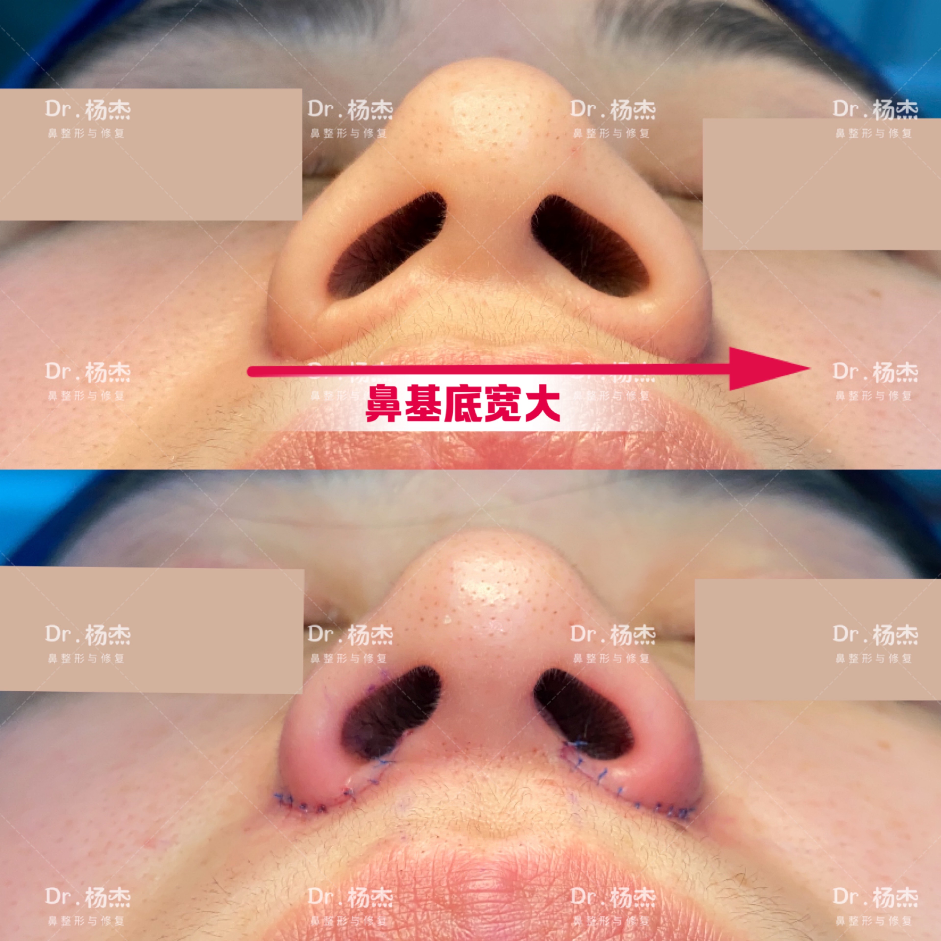 对鼻翼外扩不明显,鼻基底宽大型鼻翼宽大,选择内切鼻翼缩小效果佳.3