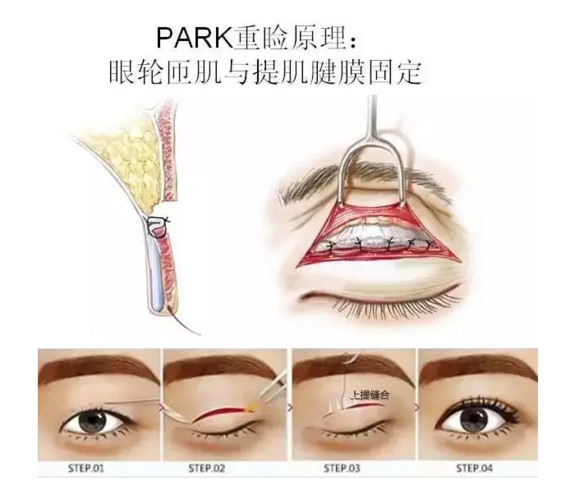 只听过埋线、切开、定点双眼皮,Park法双眼皮又是什么?_吴焱秋_副主任医师_爱问健康