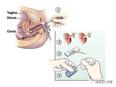 自己检查宫颈的方法图片