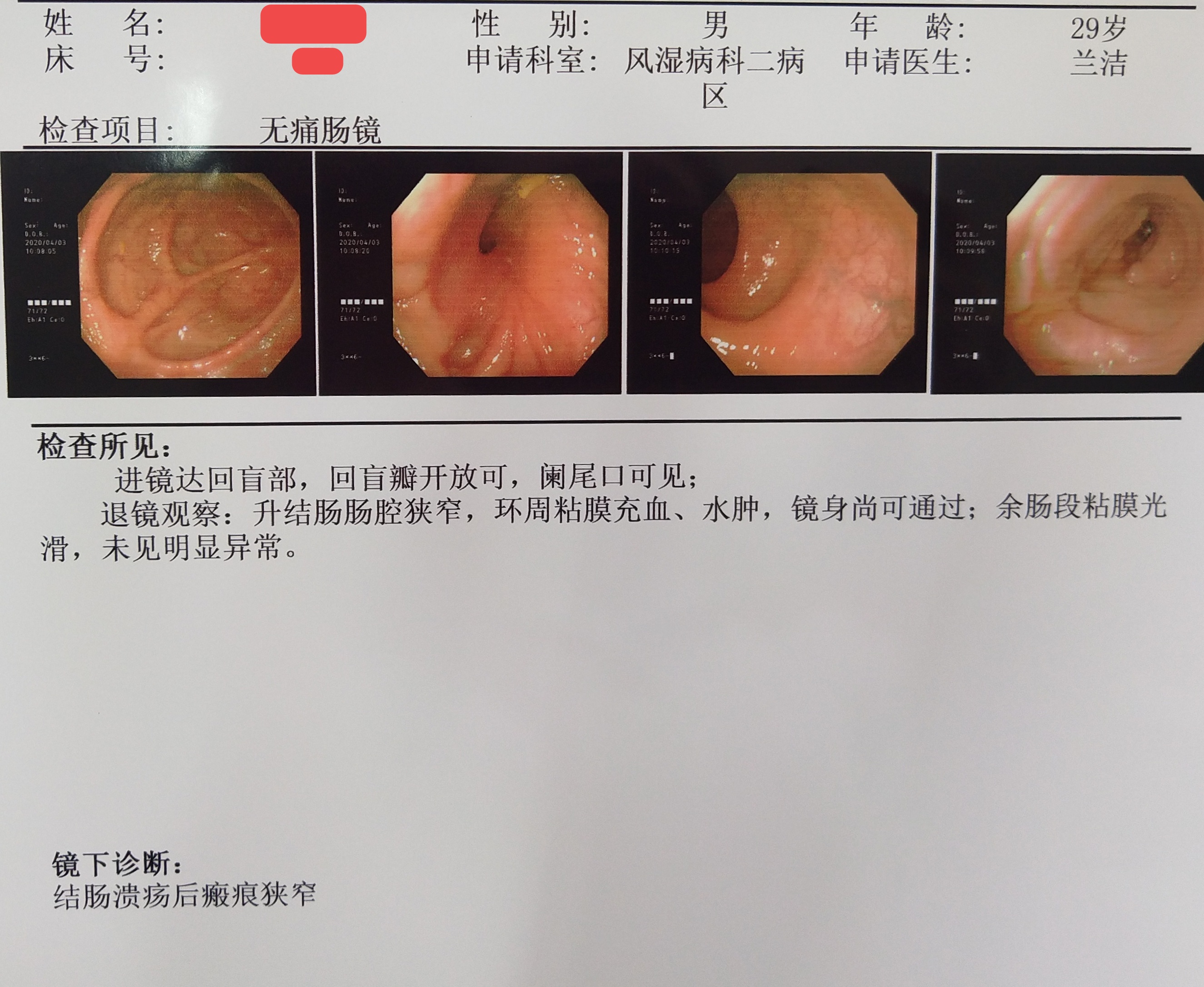 兜兜转转还是你——被肠梗阻误诊的肠白塞病