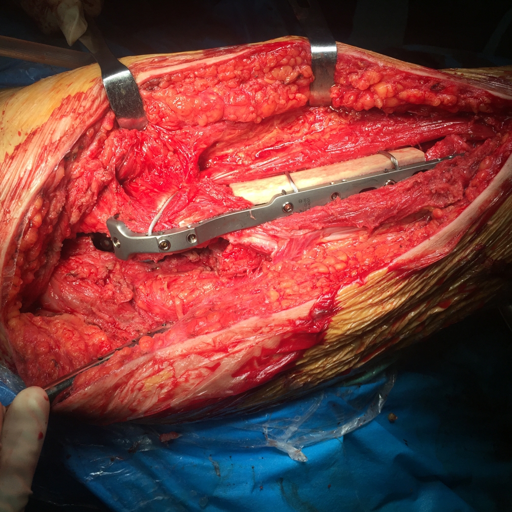 这次我们来谈谈髋关节置换以后什么情况下需要做翻修手术.