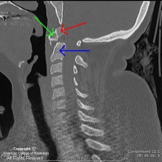 齿突小骨(体)_胡永珍_主治医师_爱问健康