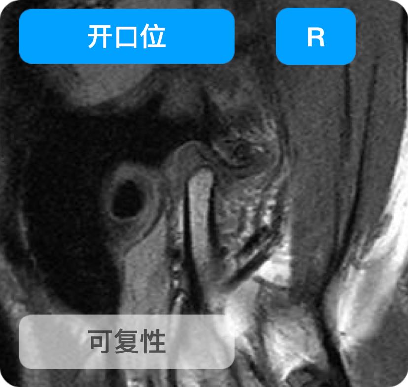 牙齿矫正前不能忽略颞下颌关节弹响_周茂强_主治医师_爱问健康