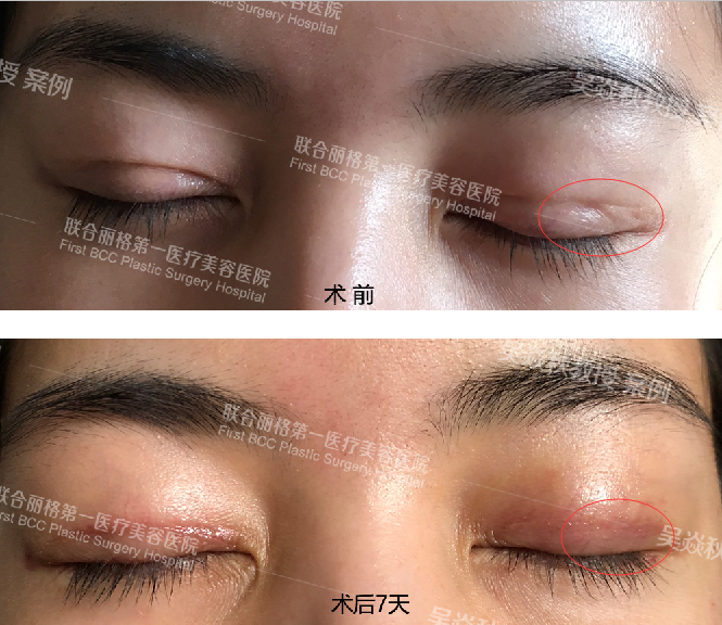 只听过埋线、切开、定点双眼皮,Park法双眼皮又是什么?_吴焱秋_副主任医师_爱问健康