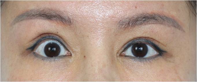 关于眼整形要知道的事(十二)双眼皮手术后,出现上睑外翻怎么办