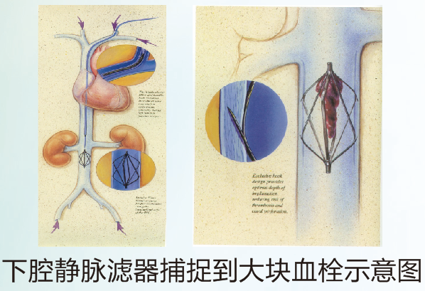 静脉滤器植入术过程图图片