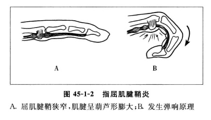 科普篇:你的手指会弹响吗?_张武_住院医师_爱问健康