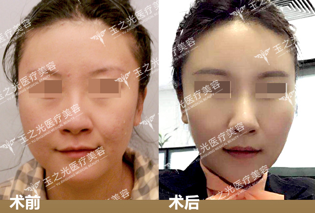 北京自体脂肪面部填充对比图.jpg