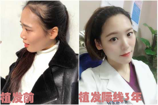 女性发量少、脱发严重是种什么样的体验？（附女性毛发改善方法）_刘长春_主任医师_爱问健康