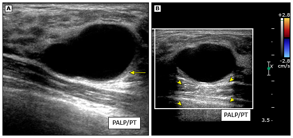 乳腺囊肿怎么回事
