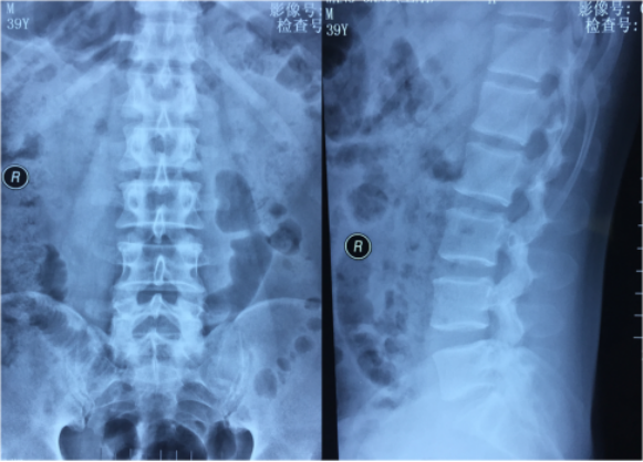 椎间孔镜手术治愈腰5骶1椎间盘突出症患者