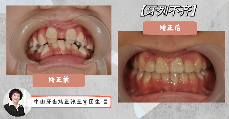 医生心得牙齿情况:双排牙,牙列拥挤,异位重叠患者年龄:14岁矫正方式