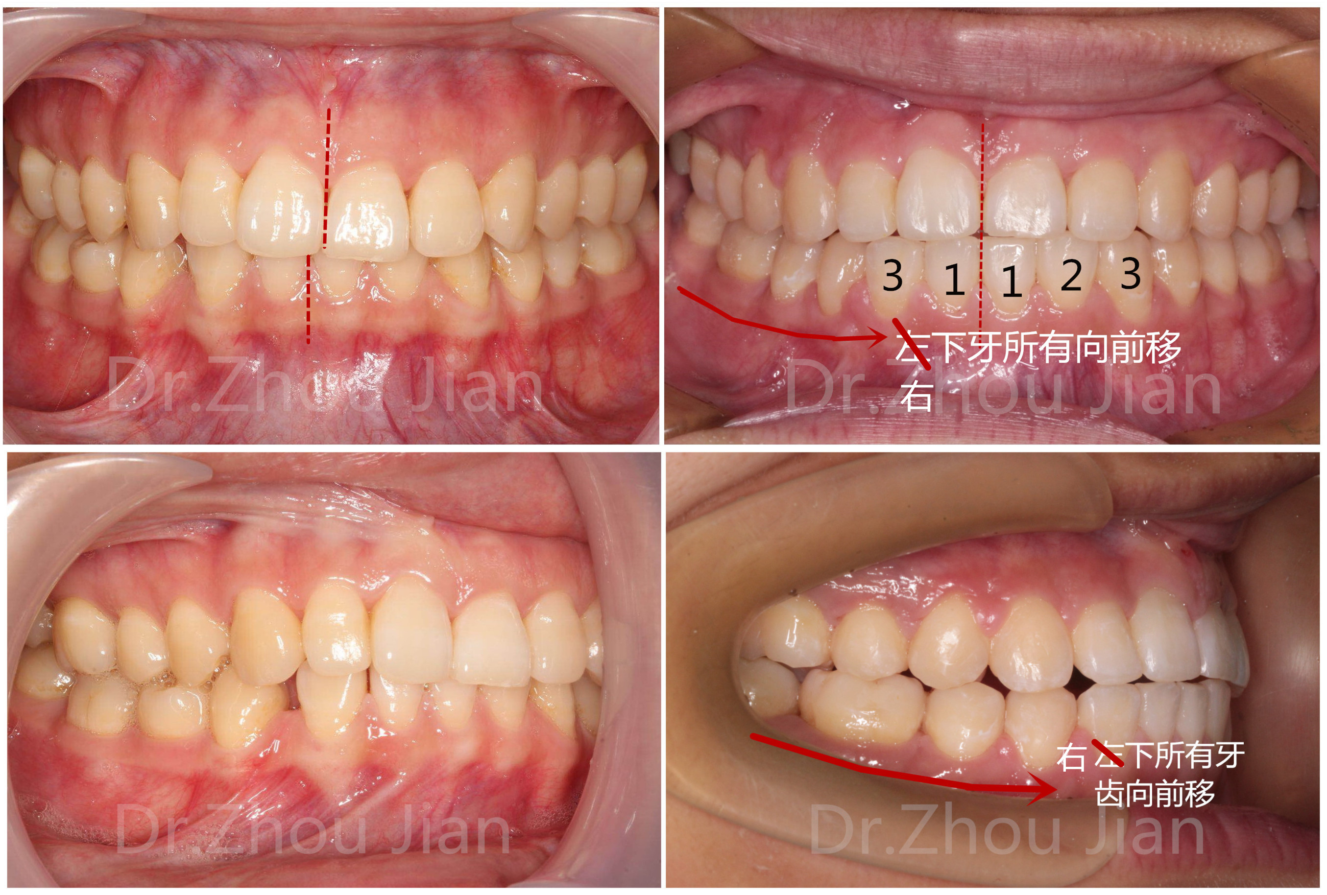 有一种牙齿矫正叫中线不齐