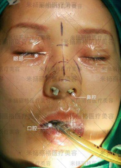 膨体真的容易感染吗?膨体偏见知多少