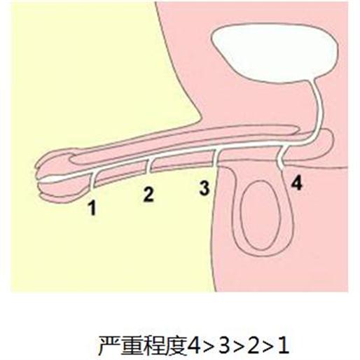 小儿尿道下裂怎么办