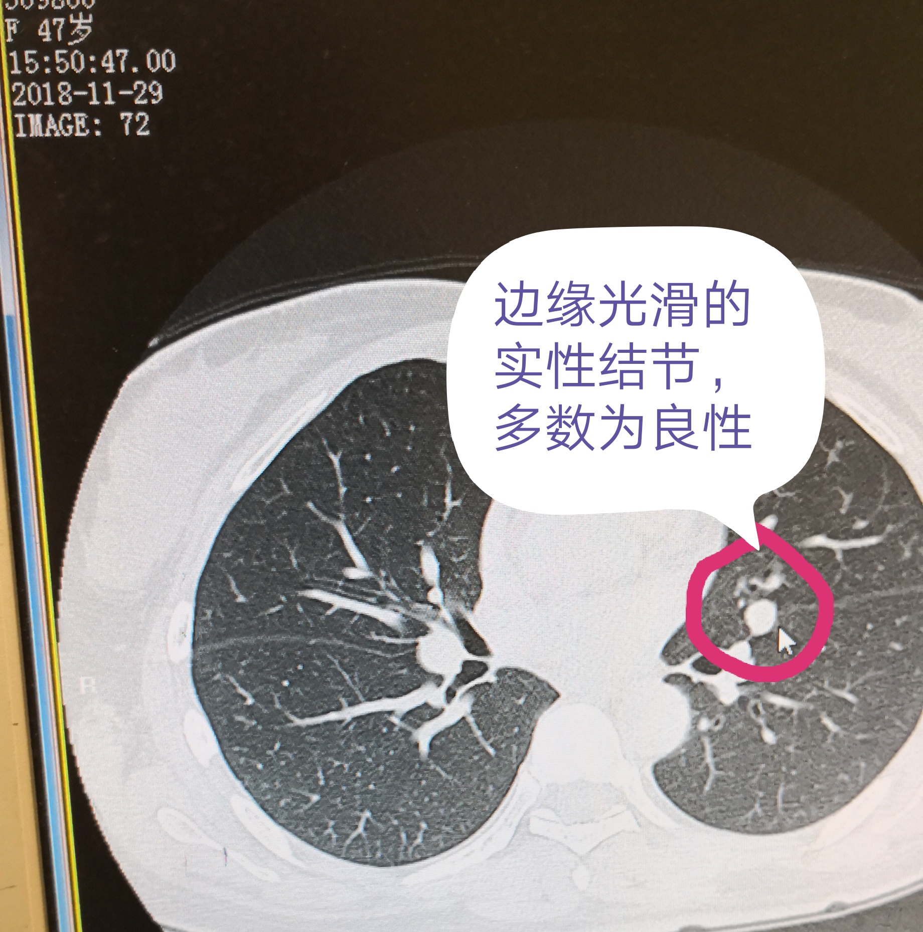 我两边都有肺小结节,我爸爸就是肺癌去世的,我好怕!