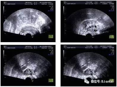 了解多囊卵巢综合症