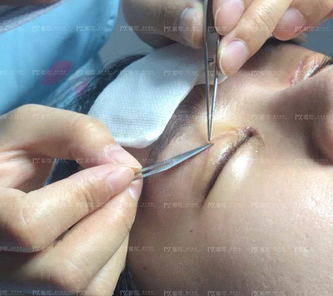 武汉蜜司仿生态双眼皮【术后拆线,换药过程】你了解吗?