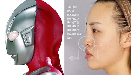 隆鼻后,别人是女神,你是"阿凡达"?