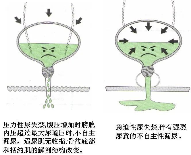 80岁以上人群患者的最困扰症状是夜间尿频和急迫性尿失禁