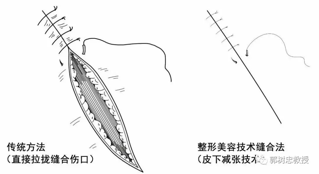 何谓伤口的美容缝合