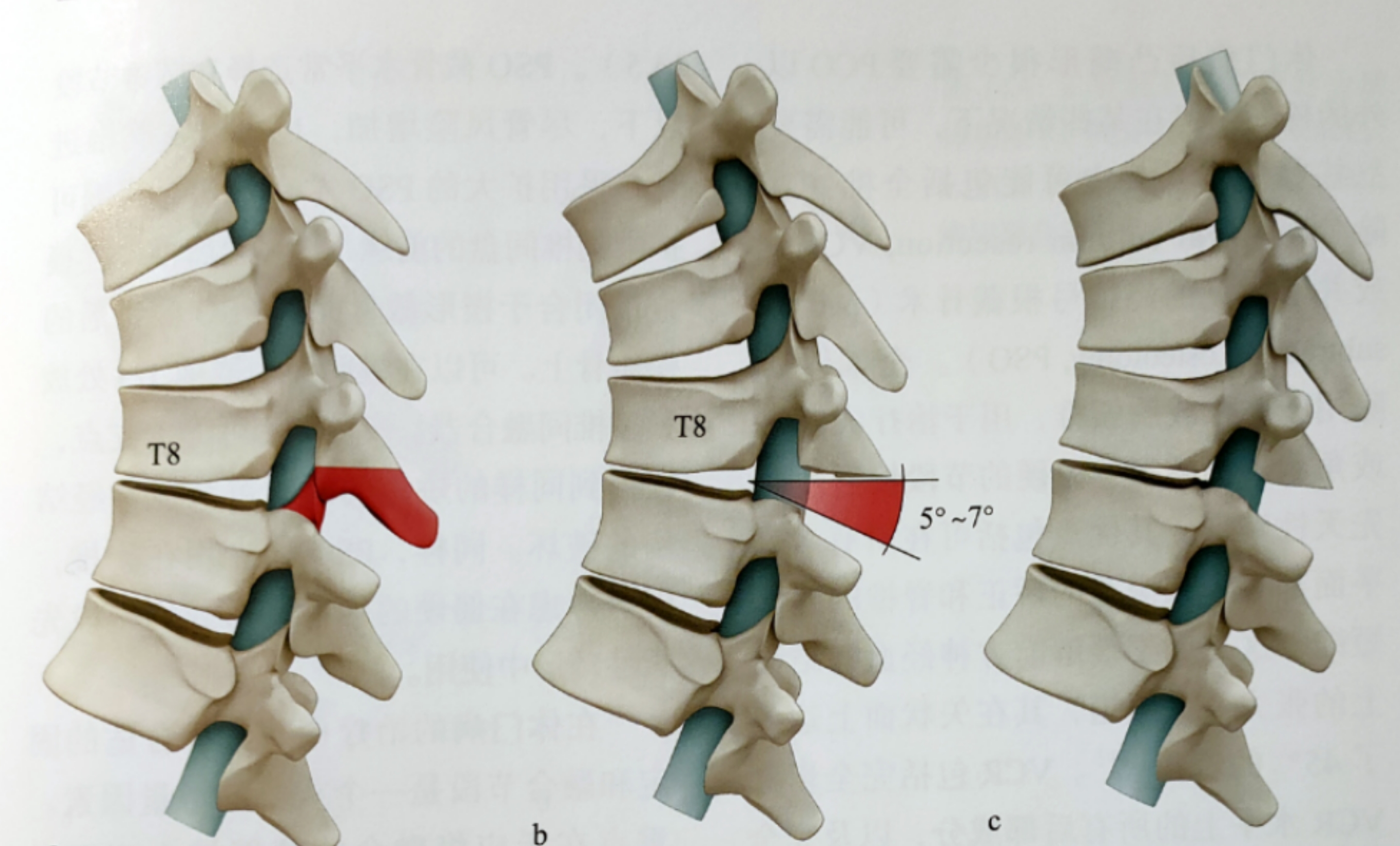 治疗休门病后凸畸形的外科技术