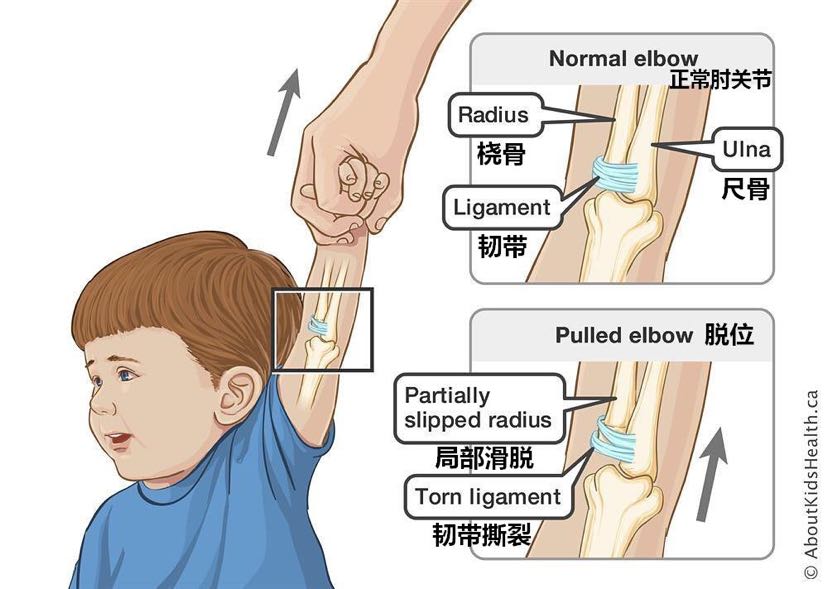 儿童最常见的脱臼:桡骨小头半脱位
