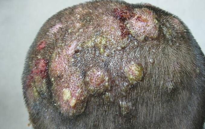 细说11种常见的真菌性皮肤病!