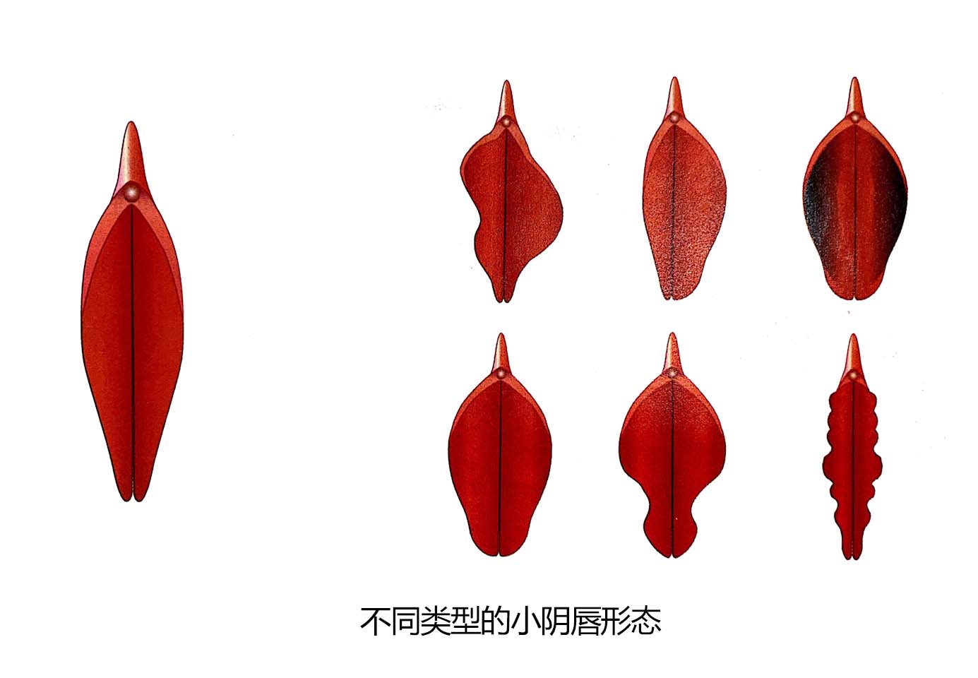 不同类型小阴唇形态.jpg