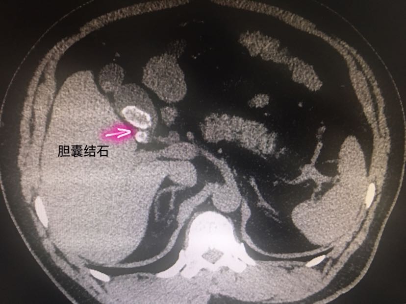 部分胆囊结石ct可显影