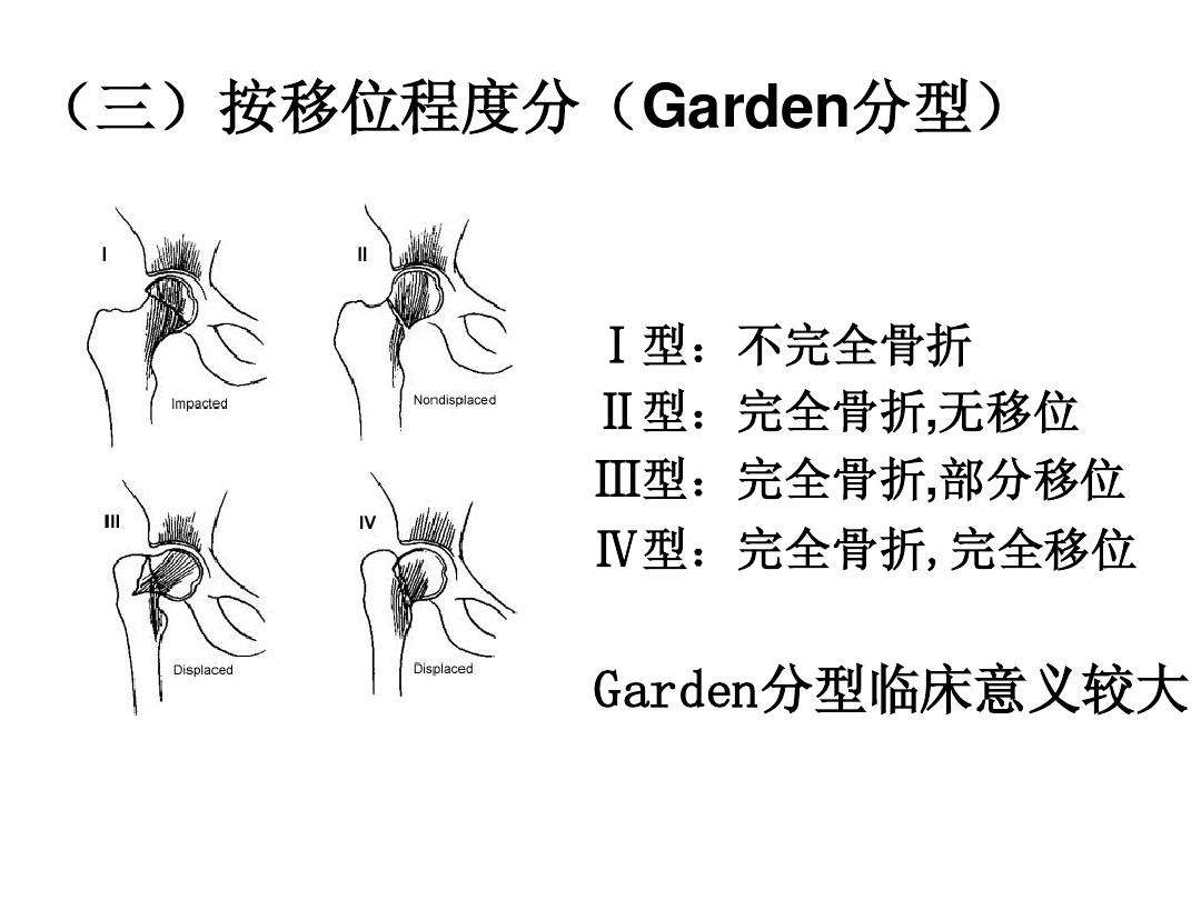 股骨颈骨折Garden分型.jpg
