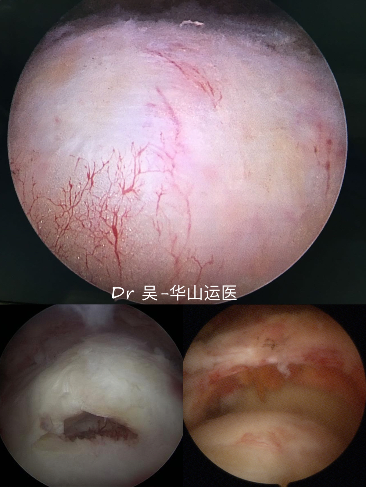 镜下肩袖 正常 撕裂.JPG