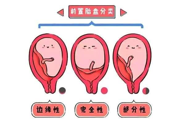 胎盘附着于子宫下段,甚至胎盘下缘达到或覆盖宫颈内口,其位置低于胎