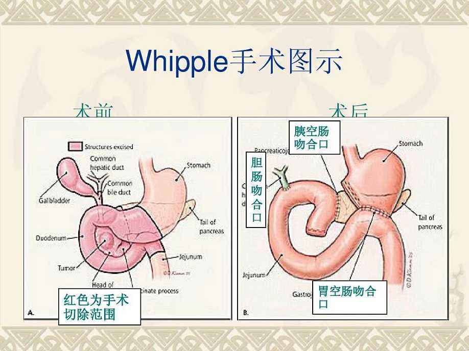 海扶高强度聚焦超声消融手术治疗胰腺癌病例分析