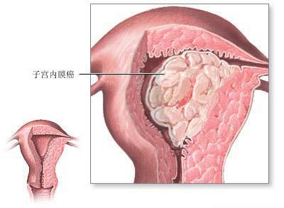 又称为子宫体癌,是妇科常见的恶性肿瘤,仅次于子宫颈癌