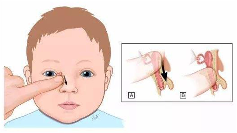 宝宝鼻泪管堵塞会有哪些症状?
