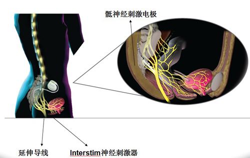 什么是骶神经膀胱电刺激(膀胱起搏器)手术?