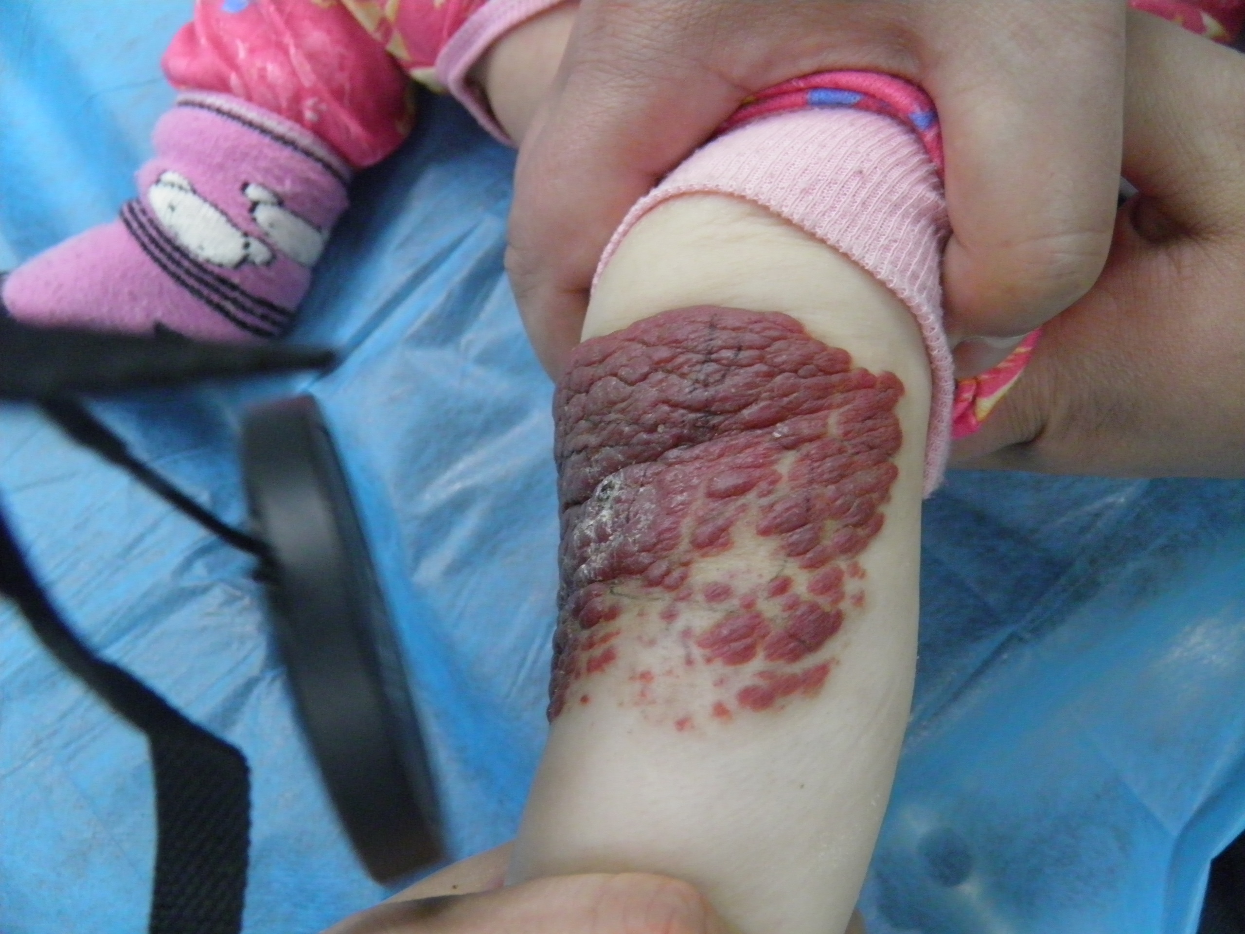 血管瘤患者多吃这些食物对身体好