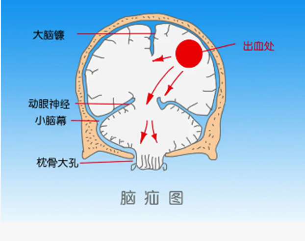 以致推压某些部分的脑组织向靠近的解剖间隙移位,突出而形成脑疝