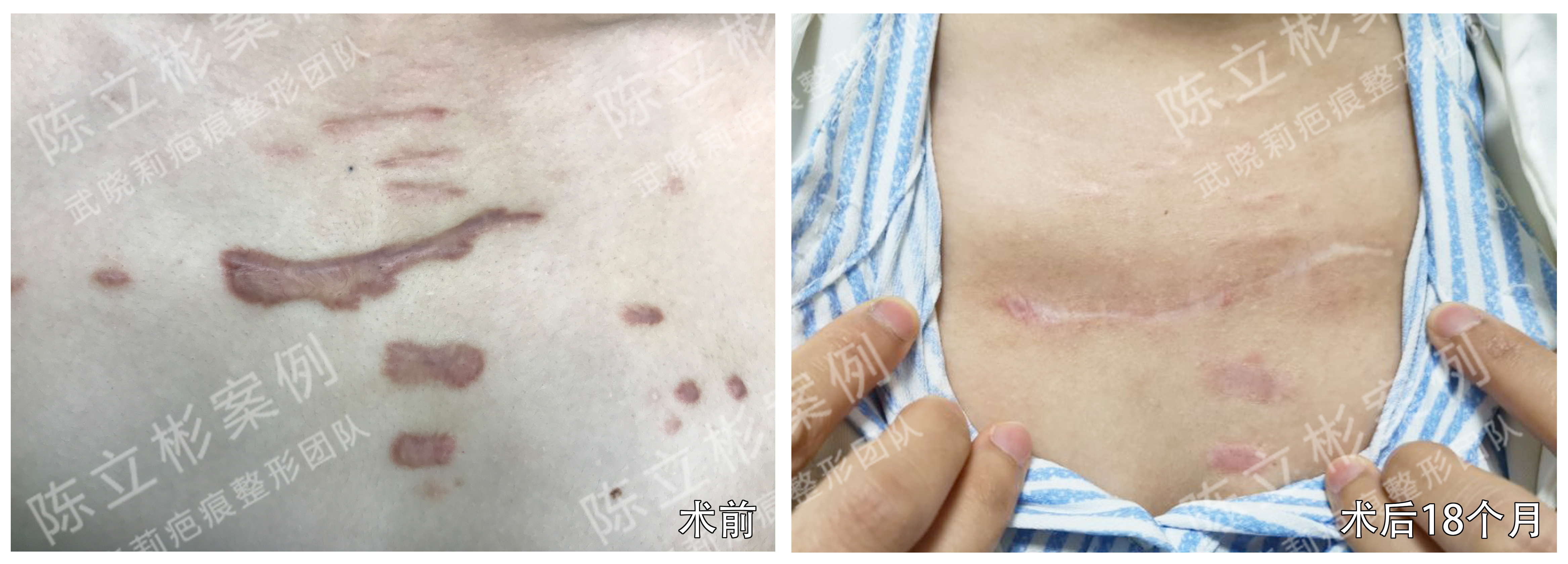 胸部疤痕疙瘩术后18个月复诊记录