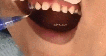 做烤瓷牙全过程，看看牙齿是怎么被磨小的！