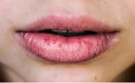 嘴干别乱舔,小心唇炎找上门!