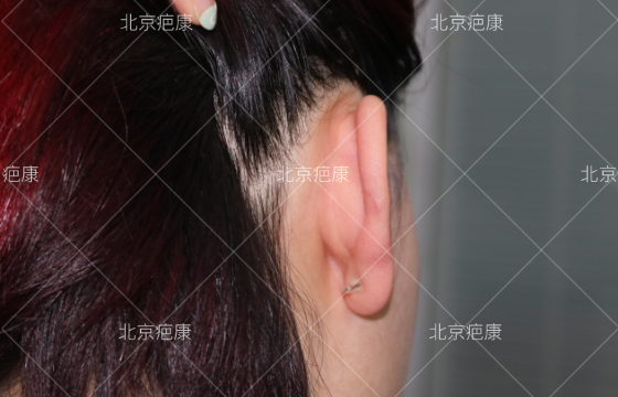 病例分析：重庆陈女士耳廓瘢痕疙瘩