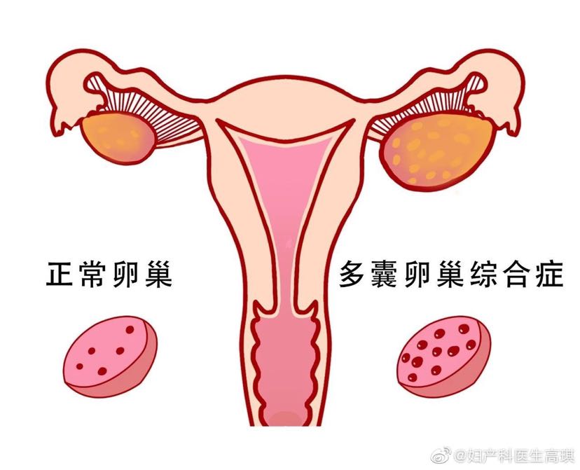 卵巢囊性结构图片