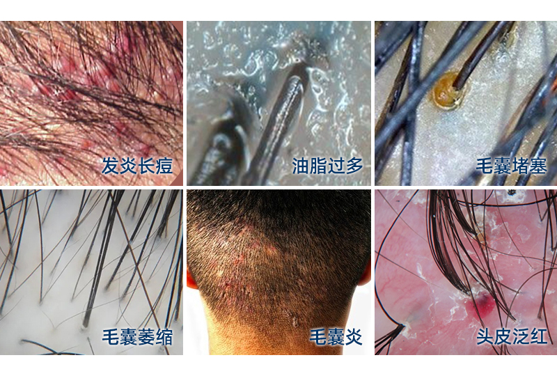 头皮痒、出油多、长痘痘就是毛囊炎吗?反复发作怎么办?_刘长春_主任医师_爱问健康