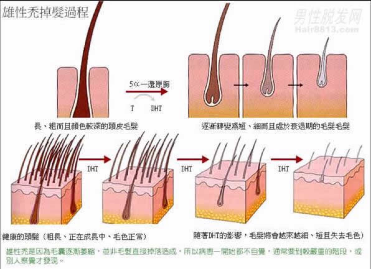 雄性禿治療