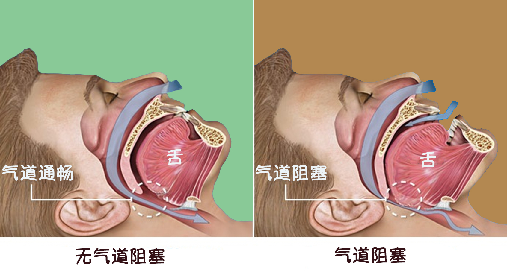 通俗地讲,当发生阻塞性睡眠呼吸暂停时,上气道会出现阻塞状态,呼吸