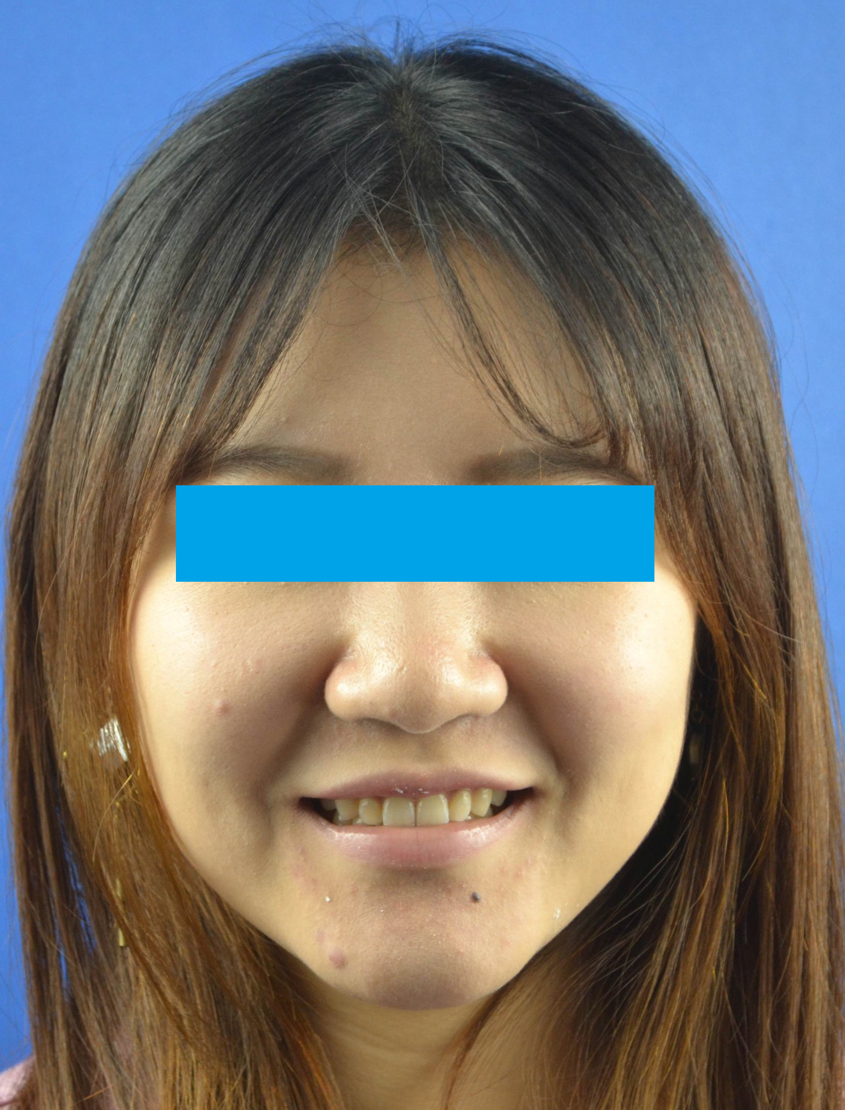 "内倾型深覆合"蜕变记